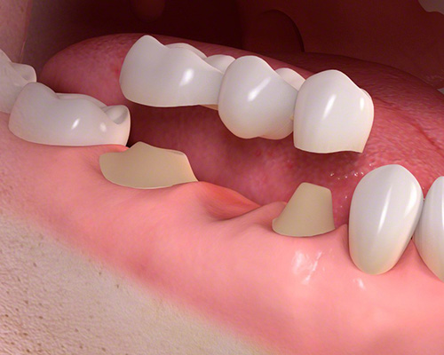 Dental Bridges