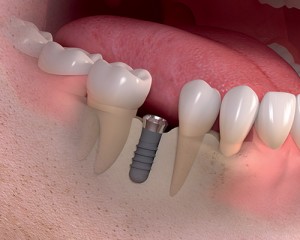 Dental Implant Post Placement