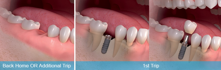 Immediate Loaded Dental Implants
