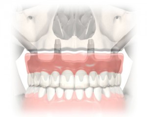 Zygoma Implants