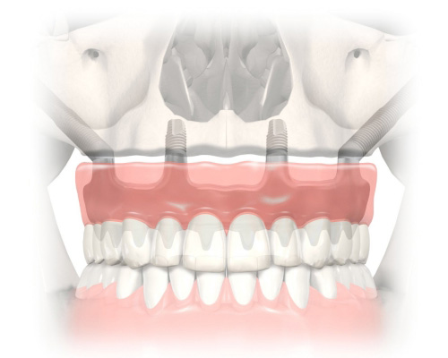 Zygoma Implants