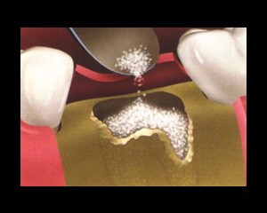 Bone Graft