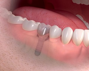 dental prosthetics