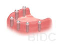 implant-bridge-step-03