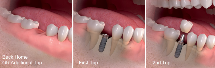 standard dental implant process