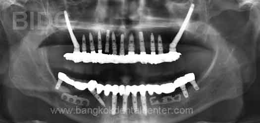 Zygoma Case