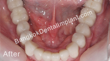 Dental-Implants-case-1