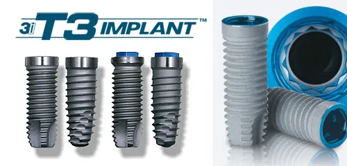 3i Implants