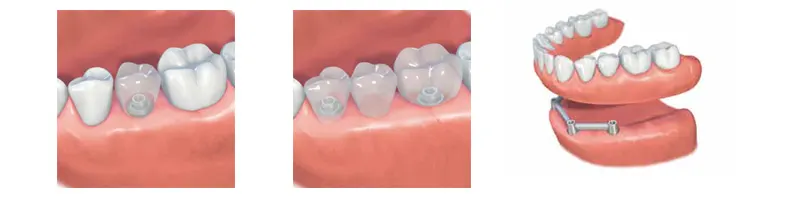 Dental Implant