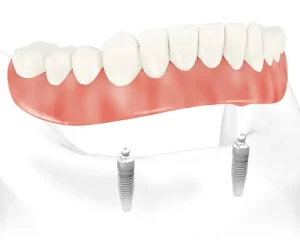 Implant Supported Overdentures Procedures