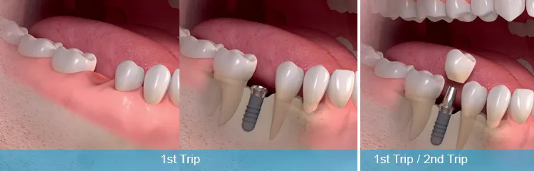 One day Dental Implant