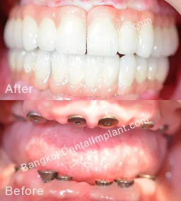 Dental Implant