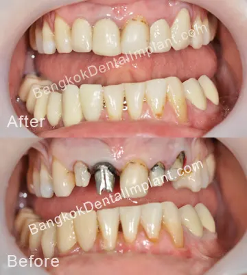 Dental Implant