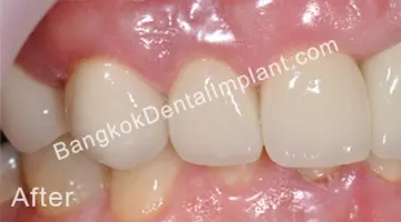 Dental Implant